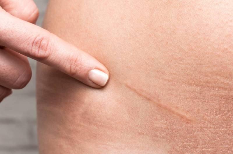 Chirurgie de la peau ou dermatochirurgie à Marseille