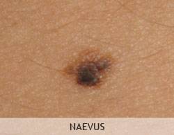 Chirurgie de la peau ou dermatochirurgie à Marseille