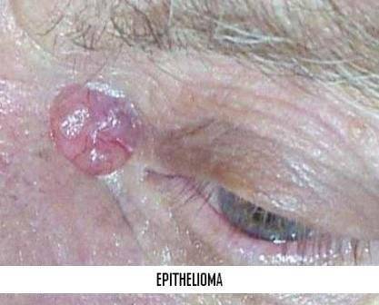 Chirurgie de la peau ou dermatochirurgie à Marseille