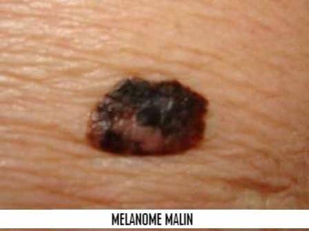 Chirurgie de la peau ou dermatochirurgie à Marseille